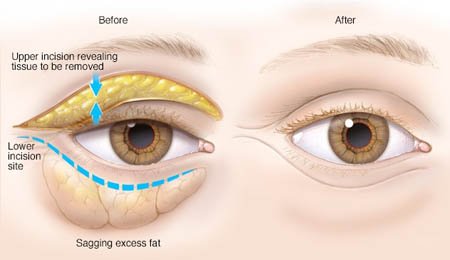 blepharoplasty in Delhi