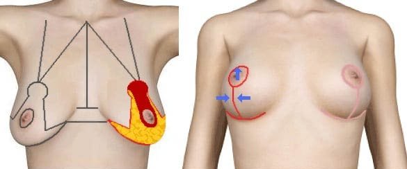 breast lift surgery in Delhi