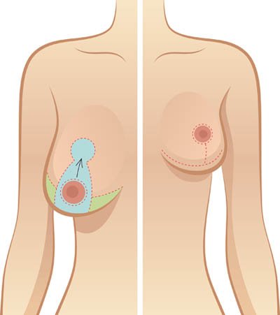 breast reduction surgery in Delhi