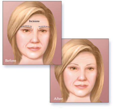 brow lift surgery in Delhi