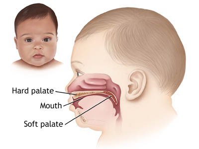 cleft lip surgery in rohini