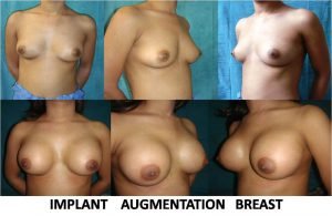 breast augmentation in Delhi