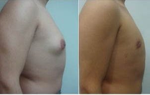 Male Breast Reduction in Delhi