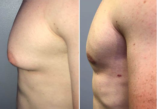 Male Breast Reduction in Delhi