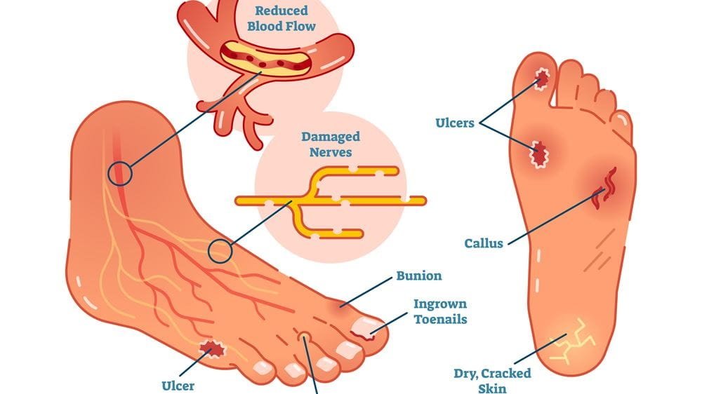 diabetic foot treatment in Rohini